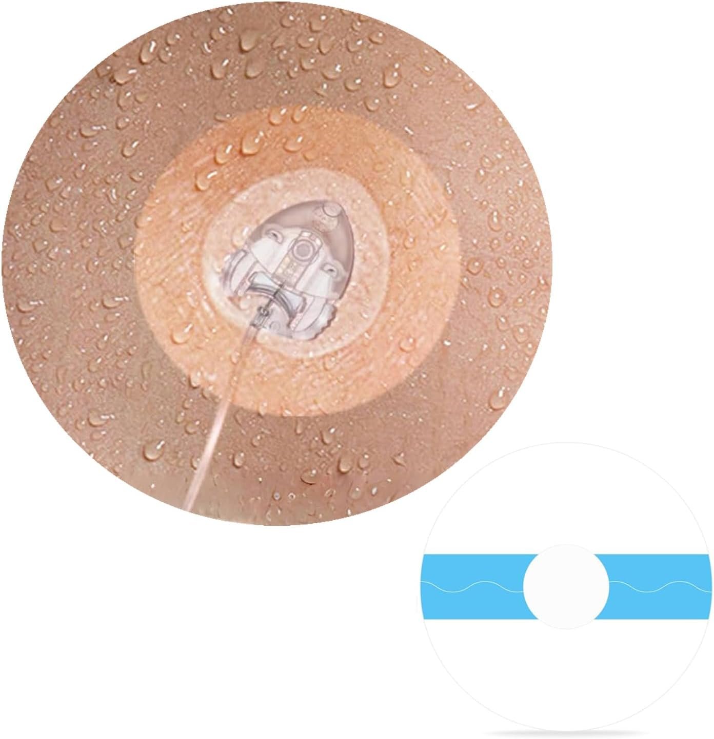 30 Pcs Waterproof Infusion Site CGM Adhesive Patches for Medtronic 780G/770G, Tandem t:Slim X2/ Mobi – Hypoallergenic Sensor Adhesive Tape with 0.8″ Hole, 14-Day Wear, Pre-Cut Breathable Clear Patch